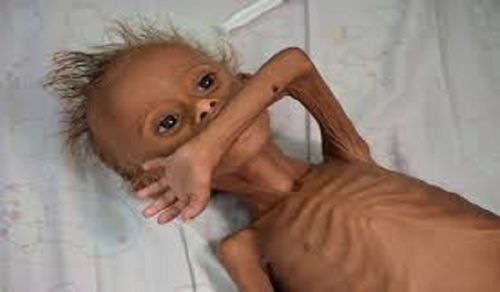 The World Turns a Blind Eye to the Starvation of Yemen’s Children